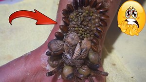 17K views · 116 reactions | Worms On Leg Removal _ Dandruff Psoriasis Treatment #684 #ticks #removetick #Dandruff #dandrufftreatment #dandruffremoval | Giant Ticks | Facebook