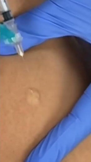 How to Give an Intradermal #Injection 💉 #TBTest #PPD #MedicalAssistant