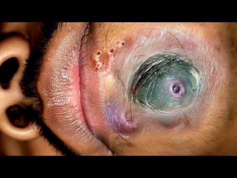 plucking Facial Huge HAIR Remove ASMR