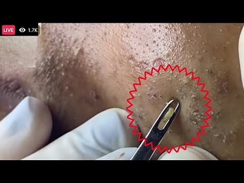 Cystic Acne, pimples & Blackheads Extraction On face Acne Treatment! part | Most satisfying face HD