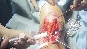 MPFL Reconstruction and Tibial Tubercle Osteotomy (TTO) for Habitual Dislocation of Patella with TT-TG>30 mm