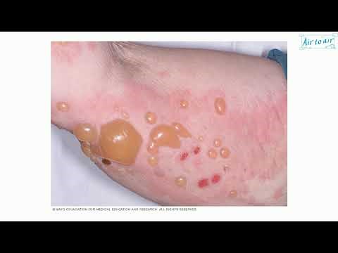 bullous pemphigoid
