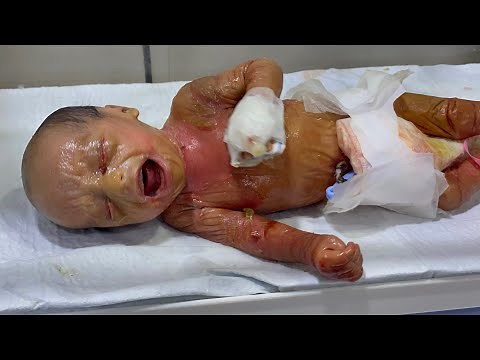 Full Detailed Care Journey of Collodion Baby | Amazing Recovery Progress #collodion #baby