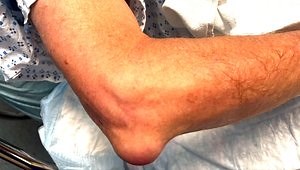 Olecranon Bursectomy