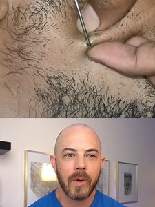 Doctor Reacts to Huge Ingrown Hair Removal