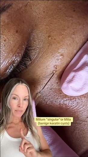 AMAZING MILIA REMOVAL AND TIPS ON HOW TO PREVENT THEM! #shorts
