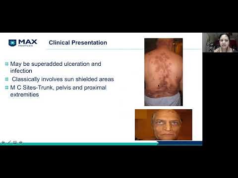 Total Skin Electron Therapy (TSET)_Dr Vineeta Goel