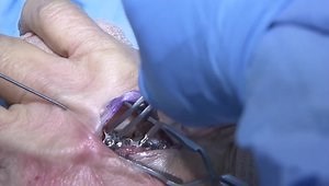 VA Locking Hand System, Metacarpal Neck Plate