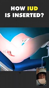 How Intrauterine Device ( IUD ) Is Inserted? | Jengle Maravilla Sabado