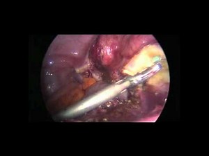 Total Laparoscopic Hysterectomy Made Easy for Enlarged Uterus with Fibroids,