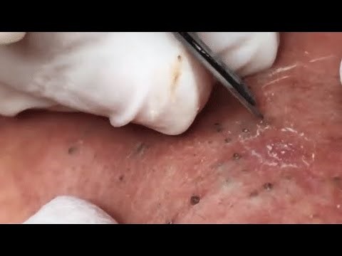 ENJOY YOUR DAY WITH GA SPA PART V #relaxing #blackheads