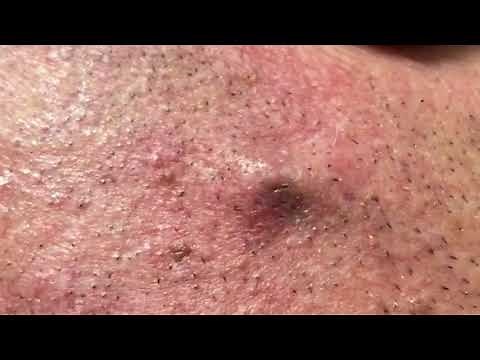 Big blackhead removal