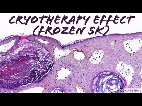 Cryotherapy Effect in a Seborrheic Keratosis (Frozen SK!)