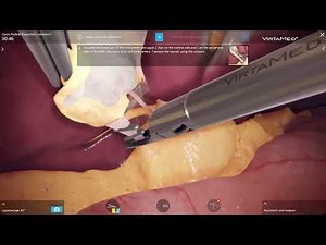 Clipping and Ligation - Short Cystic Duct