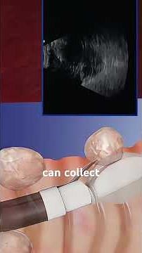 Bronchoscopy(3DAnimation)#medical #medical3danimation #medical3d #bronchoscopy #bronchoscope