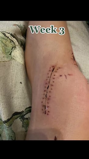 ACL-revalidation sur TikTok