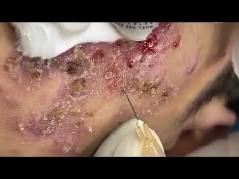 BEST BLACKHEAD AND WHITEHEAD REMOVAL! SEVERE ACNE TREATMENT SATISFYING AND RELAXING VIDEO