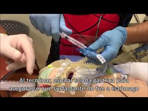 Surfactante Mínimamente Invasivo - Técnica LISA