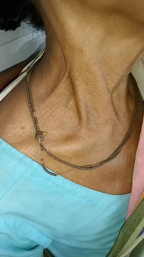 Raised JVP with positive hepatojugular reflux #reels #JVP | MedLearn Easy