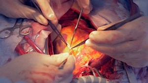 clip-1009751942-close-human-heart-getting-microcut-during-open