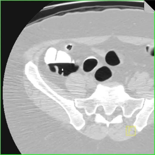 Virtual colonoscopy with prone imaging cecum
