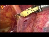 Lap High Anterior Resection and Hepatic Wedge Resection • Video • MEDtube.net