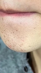 Green mask stick 🤡🤡 #greenmaskstick #porevacuum #porecleaning #extractions #greenmask #acneskincareroutine #skincareviraltiktok #skincarevideo | Janet Moody