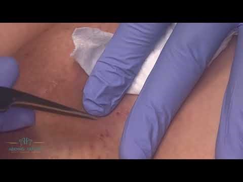 Ingrown Hair Removal - Action - Episode 27