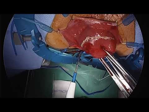 A New Approach for Rectal Prolapse: Perineal Proctectomy with TAMIS Rectopexy and Mesh Fixation