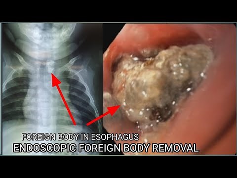 Endoscopic Foreign Body Removal concrete stone #BD_ENDOSCOPY