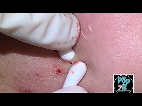 Q-Tip Extractions on cheeks PART 2. Blackheads, whiteheads, and Milia popped and removed.