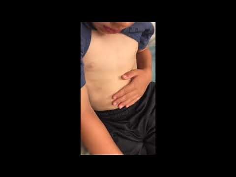 Pediatric Retractions