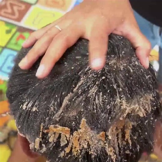 WAH!! My Beautiful Wife Satisfying King Dandruff And Giant Worm Nest On Scalp #813 Part 11 | Help remove ticks | Facebook
