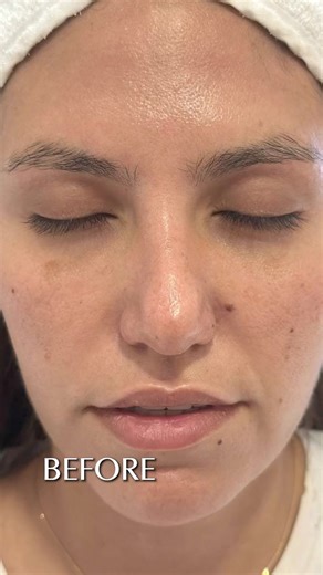 Experience the transformative power of Micro-needling and Exosomes +...