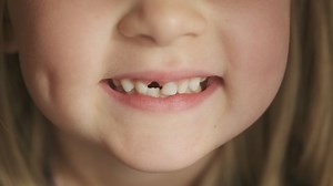 clip-1078699439-close-up-mouth-child-has-lost-milk-teeth