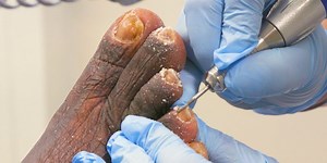 How toenail fungus and feet are treated during a medical pedicure