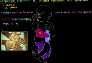 What is congenital syphilis?