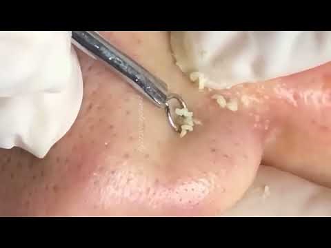 how to squeeze blackheads off your nose permanently
