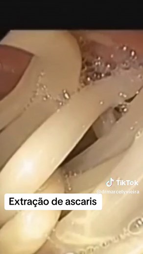 Extração de Ascaris Lumbricoides com Endoscopia