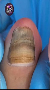 Trusted Techniques to Boost Runners to Prevent Calluses and Cracks 💟🍒 #FootCareTips #FootWellnessUSA #HealthyHabits | NC State Wolfpack on TheWolfpacker.com