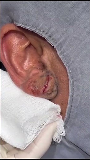 Massive Ear Cyst Comes Out After Two Decades