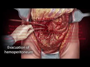 Laparotomy Small Bowel Resection