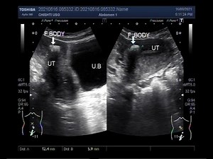 Foreign Body in Uterus.