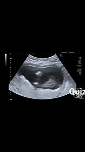 Female foetus ultrasound ❤️ | Jobain M Francisca