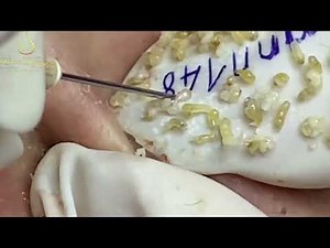 Loan Nguyen Acne Treatment 1426h