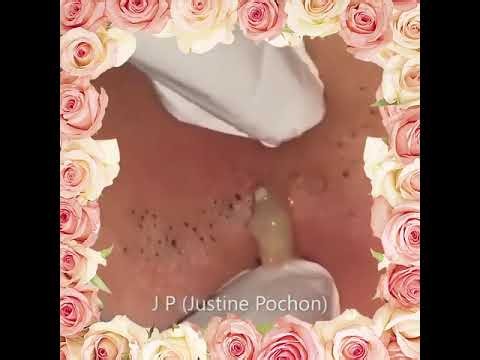 Blackheads Removal #661 | Acne Treatment and Very Satisfying Satisfying Pimple pop #blackheads