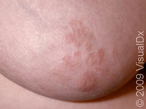 Nipple Dermatitis | Symptoms & Treatment