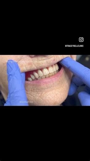 Patients often attend... Requesting fillers around the lips, definition around the mouth Often teeth or loss of teeth can be a cause if this Missing teeth Worn teeth Aged teeth Therefore always important to ensure that the teeth are inntge best position, condition they can be and support can often be restored and even fullness in an upper lip Simply with dental work | Tracey Bell