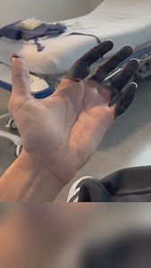 Deep frostbite ❄️ | Mahyar "Max" Maddahali, MD