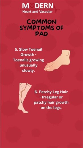 Common and Advanced Symptoms of PAD